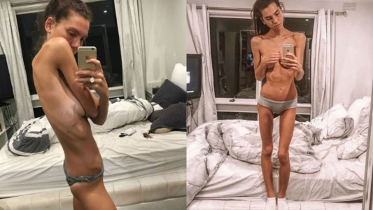 La joven que sufrió anorexia, se recuperó y ahora logró un sorpresivo cambio físico
