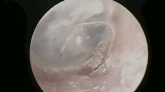 Video impactante: hallaron una araña que tejía su tela en el oído de un hombre