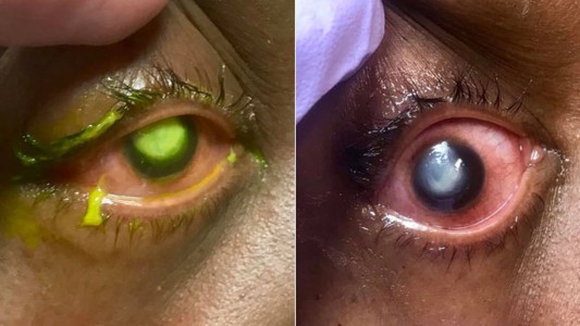 Fotos: así pueden quedar los ojos si la persona duerme con los lentes de contacto puestos