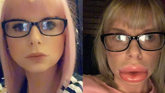 Así quedó una joven por una reacción alérgica que le causó el botox