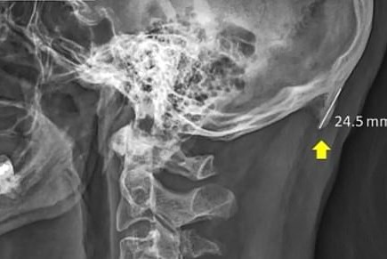 Por el uso del celular, a los humanos les está saliendo una espina en el cerebro