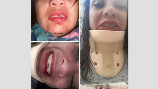 Iba a su despedida de soltera y terminó con un cuello ortopédico y los dientes rotos