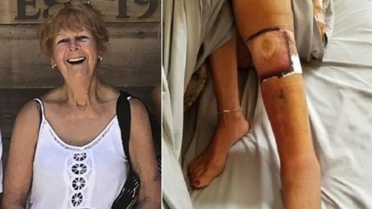 Murió una mujer tras infectarse con la bacteria "come carne"