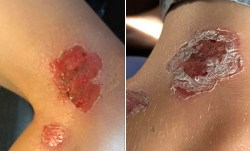 Así quedó el cuerpo de un nene tras ser atacado por la bacteria "come carne"