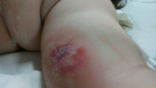 Murió una beba que habría sido quemada por error en un hospital