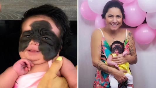 Luna, la beba con una marca de nacimiento en la piel que enfrenta a los haters en las redes sociales