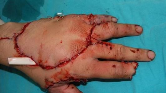 La increíble operación de un médico que reconstruyó una mano triturada