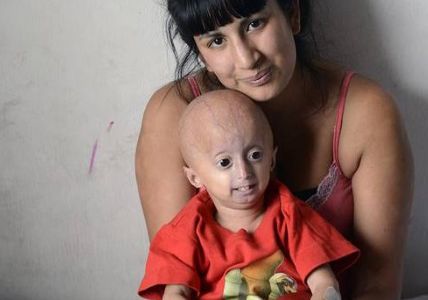 La triste historia del nene argentino que envejeció de golpe