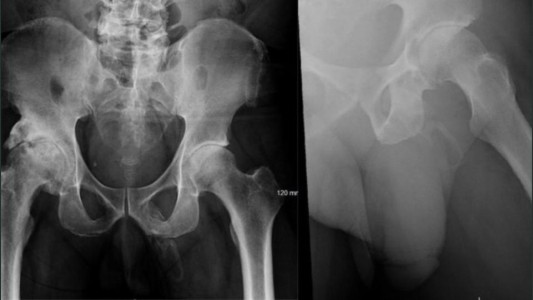 Por un accidente descubrieron que su pene se transformaba en hueso: se escapó del hospital