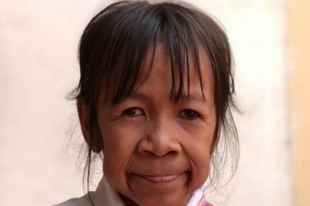 El extraño caso de la nena con "cara de abuela"