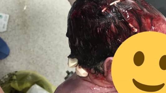 La foto viral del bebé que nació con un DIU pegado en la cabeza