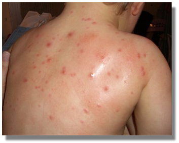 Murió un chico con varicela en La Rioja y su hermano está internado