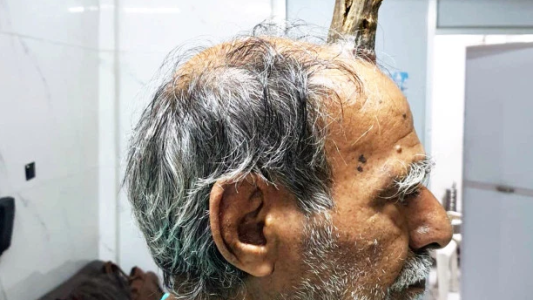 El extraño caso del hombre que le creció un "cuerno del diablo" tras un golpe en la cabeza