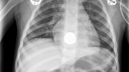 Una nena de dos años se comió una pila de litio y estuvo a punto de morir