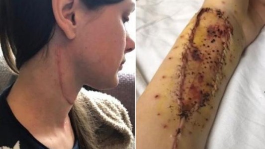 Reconstruyeron la lengua de una joven con parte del músculo de su brazo