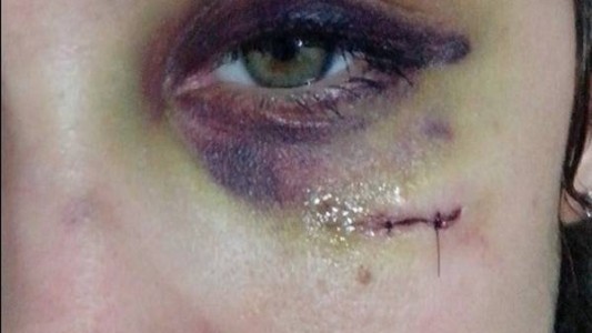 Su ex novio le deformó la cara y ella lo mostró por Facebook