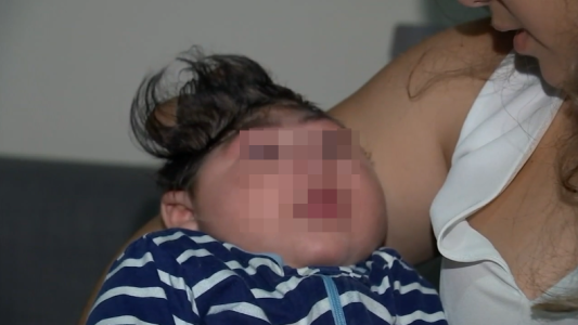 El milagroso caso del bebé que sobrevivió pese a nacer sin una parte de su cráneo