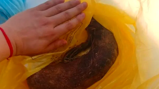 La joven a la que le sacaron casi dos kilos de pelo del estómago