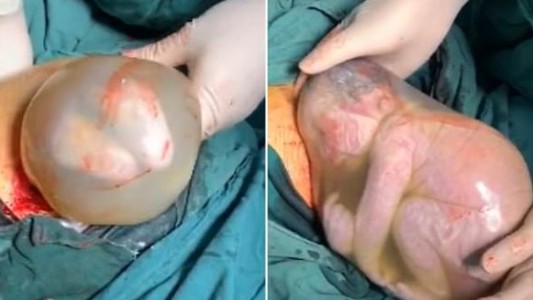 El bebé que nació dentro del saco amniótico y estuvo dos minutos sin respirar