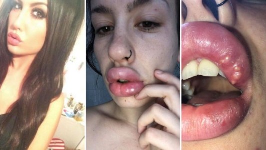 Era adicta a la cirugías estéticas y terminó con los labios llenos de pus