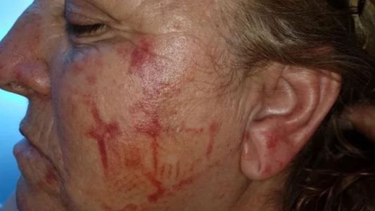 Brutal ataque motochorro: asaltó a una mujer y le dejó la zapatilla marcada en la cara