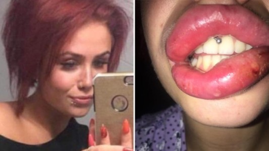 Pagó 200 dólares para una cirugía estética y casi pierde los labios