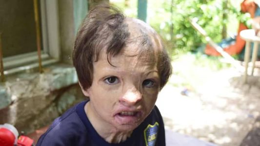 Un nene quemado en el incendio de su casa, a punto de ser desalojado