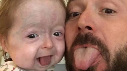 Tiene dos años pero parece anciana por la enfermedad de "Benjamín Button"