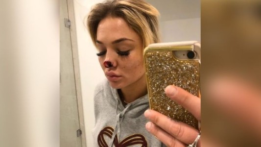 Un hombre le arrancó un pedazo de nariz a su ex novia