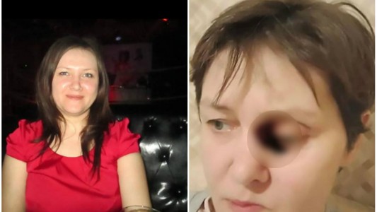 La terrible enfermedad que sufre una mujer: le carcome la cara y no descubren las causas