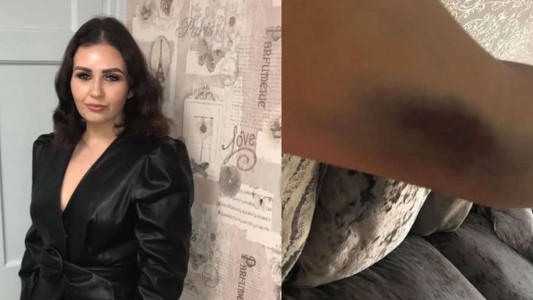 Le descubrieron unos moretones en el cuerpo y murió una semana después