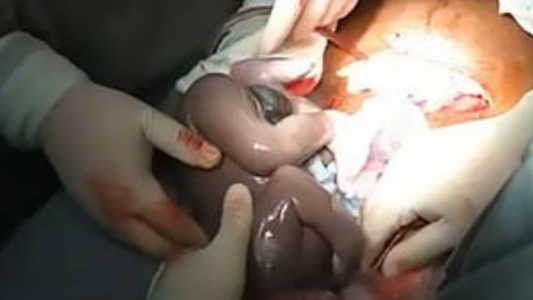 Video: el momento en el que un bebé nace dentro del saco amniótico