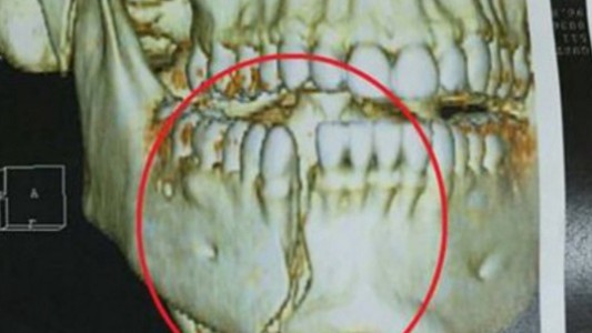 Brasil: así quedó la mandíbula del policía herido por rugbiers argentinos