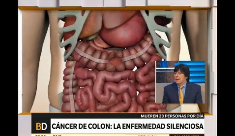Cáncer de colon: la enfermedad silenciosa