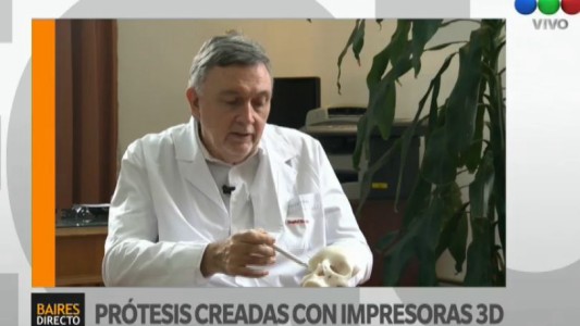 Implantaron prótesis oculares personalizadas impresas en 3D