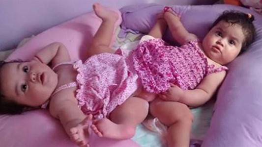 Murió Bianca, una de las siamesas separadas en el Hospital Posadas