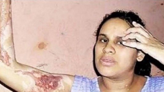 Ex director del INADI prendió fuego a su pareja, quedó libre y le volvió a pegar