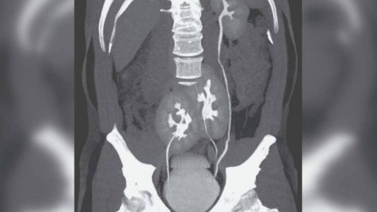 Fue al hospital por un dolor de espalda y descubrieron que tenía tres riñones