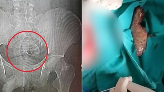 Operaron a un hombre para sacarle un pez del recto