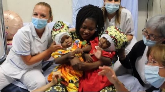 Hazaña médica: separaron a siamesas unidas por la cabeza