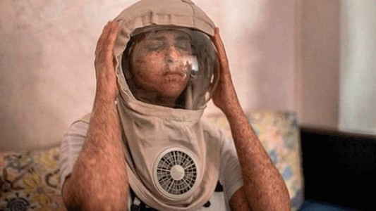 La mujer que vive de noche o con casco de astronauta porque es alérgica al sol