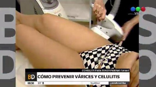 Cómo prevenir várices y celulitis