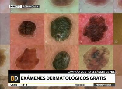 Semana del lunar: exámenes dermatológicos gratuitos
