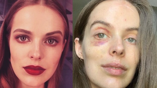 "Mostrar el verdadero yo": modelo exhibe en redes las lesiones de las enfermedades que padece