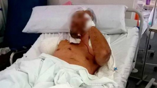 Le amputaron un brazo a un ladrón que fue atacado por un perro pitbull