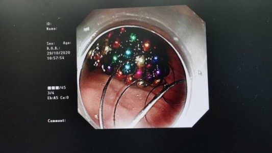 Un nene se tragó 123 bolitas magnéticas mientras miraba televisión