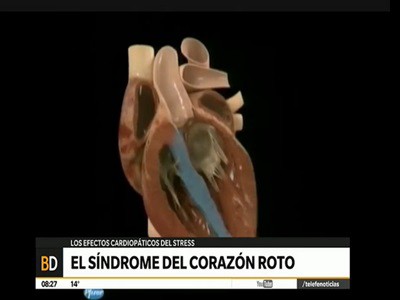 El síndrome del "corazón roto"