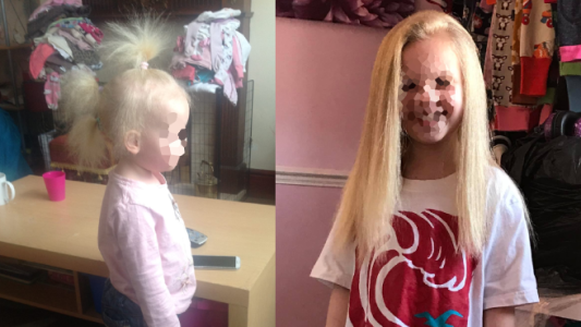 La extraña enfermedad que padece una nena que le impide peinarse
