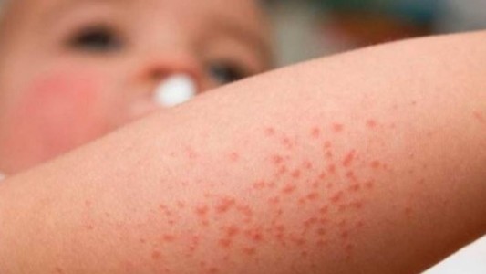 Primera campaña sobre la "dermatitis atópica", la segunda enfermedad de la piel más diagnosticada