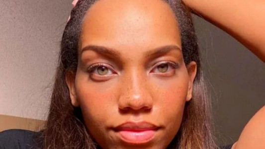 Una joven modelo gastó 7.000 dólares para reducir el tamaño de su frente